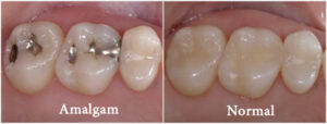 Amalgam-ve-Normal-Dolgu